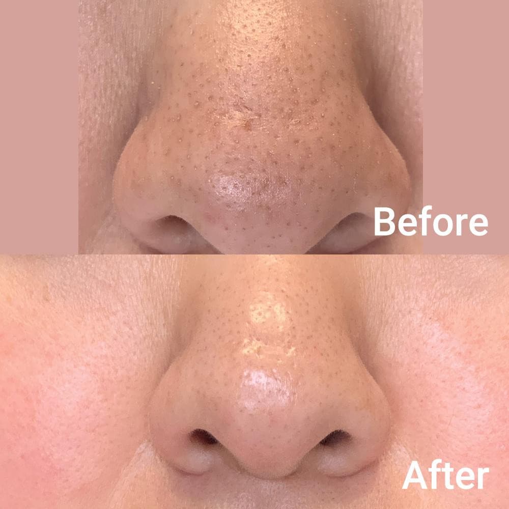Medicube Zero Pore Pad 2.0
