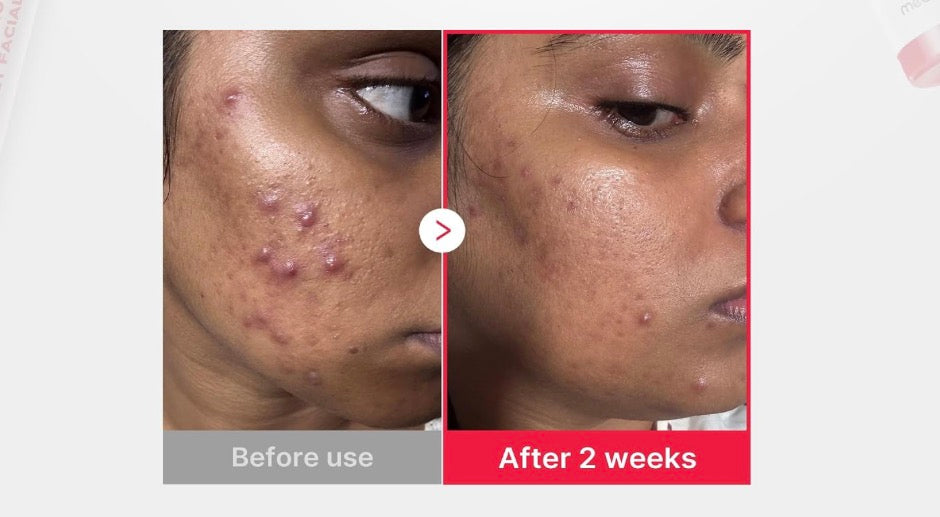 Medicube Hypochlorous Acid Daily Facial Spray (125ml)
