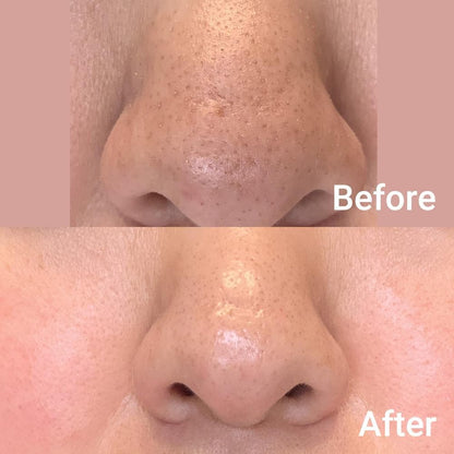 Medicube Zero Pore Pad 2.0